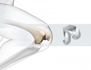Exemple d’usinage : opération de finition d’une prothèse de genou en Chrome-Cobalt