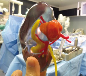 Le matériau VeroClear transparent de stratasys permet au Dr. Bernhard de voir l'intérieur du rein et d'estimer la localisation précise et la profondeur de la tumeur
